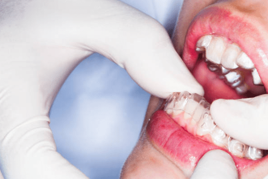 Types of Invisalign Available in Canada