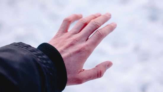What is Frostbite