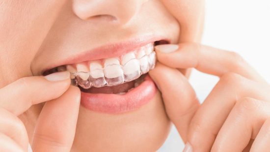 What is Invisalign